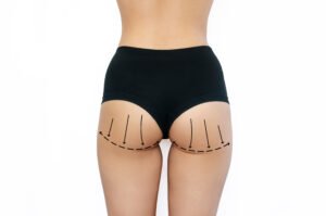 liposuccion culotté de cheval - fessier femme