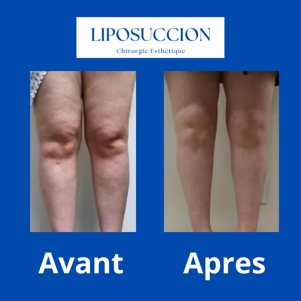 AVANT 11