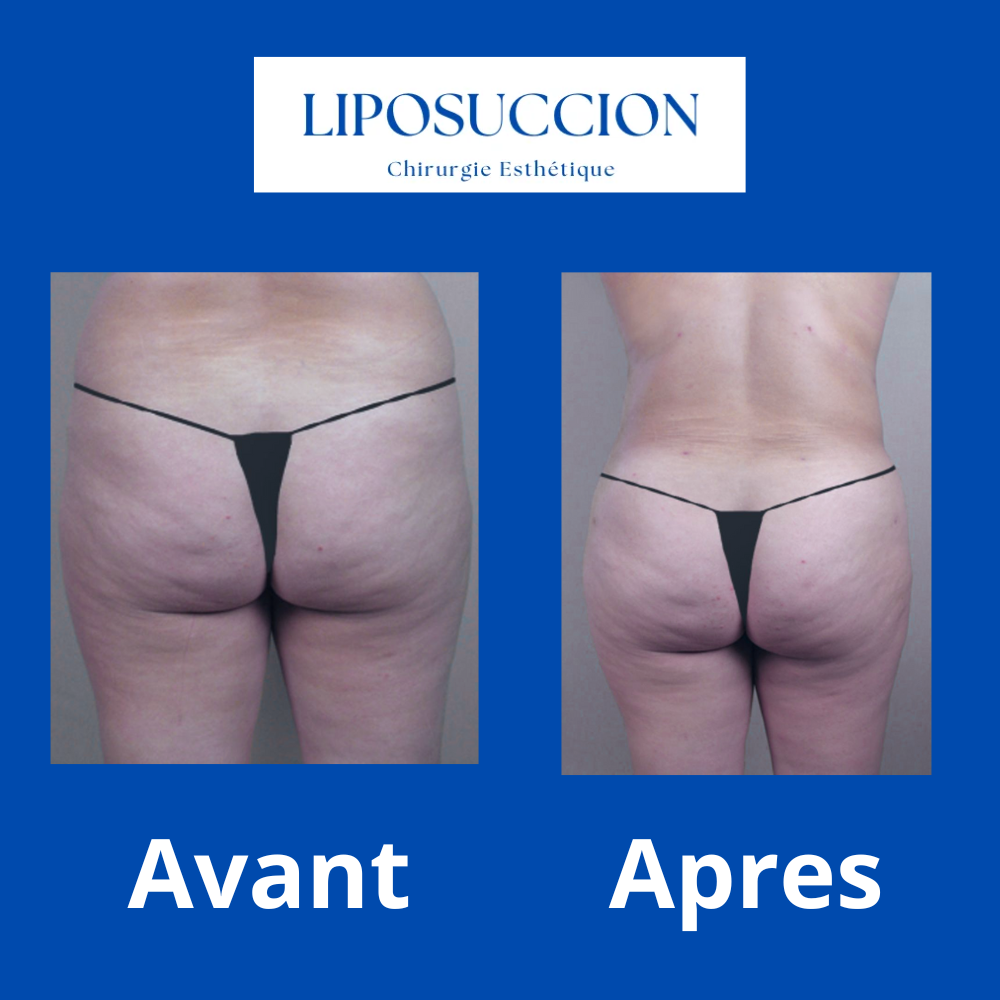 Liposuccion hanches avant après 5 liposuccion hanches avant après